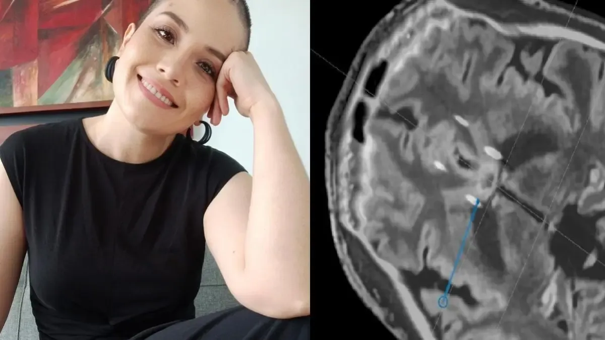 ¿Existe una operación para mejorar la depresión? La historia de una mujer que aprobó el procedimiento cerebral pionero

 – En la mira
