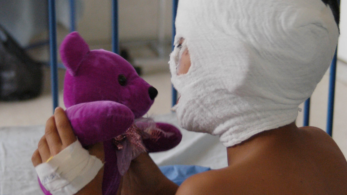 Más de 30 personas sufrieron quemaduras de pólvora en Nariño; Una de las víctimas es un niño de 4 años con heridas faciales y ojos dañados.

 – En la mira